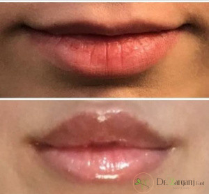 تزریق ژل لب درد دارد ؟