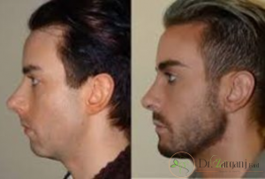 شماره 3 : زاویه دار کردن صورت با ژل، برای چه افرادی مناسب تر است؟