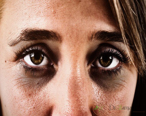 تزریق فیلر برای سیاهی دور چشم 