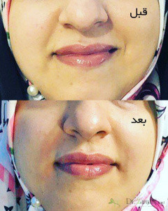 تفاوت انواع اژل ها