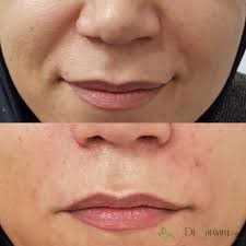 بهترین مارک ژل برای خط خنده؟