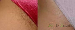عوارض استفاده از تیغ برای رفع موهای زائد بیکینی