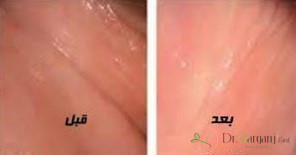 1ـ لیزر مونالیزا برای چه منظور استفاده می شود؟