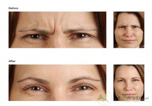 عملکرد ژل های تزریقی صورت چگونه است؟