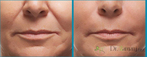 6-ژل های تزریقی چگونه موادی می باشند؟