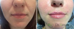 چه کسانی برای تزریق ژل گزینه های مناسب تری هستند؟