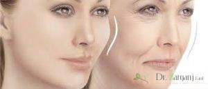 چند نکته قابل توجه درمراقبت های بعد از تزریق ژل فیلر