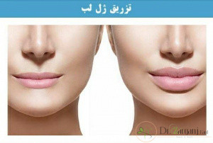 مراقبت بعد از ژل لب