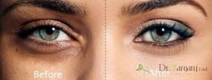در چه زمینه هایی از کربوکسی تراپی استفاده می شود؟