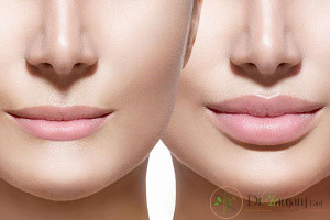 تزریق ژل در لب ها چگونه است؟