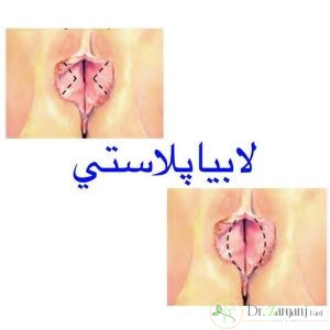 عوارض عمل لابیاپلاستی چیست