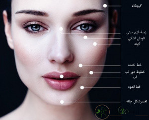 ژل فیلر