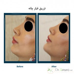 مزایا و کاربردهای تزریق فیلر چانه چیست؟