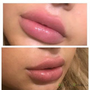 بهترین نوع ژلی که برای تزریق لب مورد استفاده قرار می گیرد کدام است؟ 