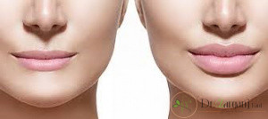 چرا افراد تزریق ژل لب را انجام می دهند؟
