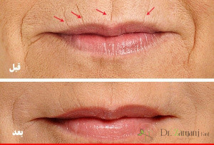 آیا ژل اسید هیالورونیک پرفکتا عوارض جانبی دارد؟