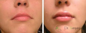 5ـ از تزریق ژل برای چه مواردی استفاده می شود؟