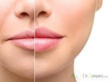 2ـ ژل هیالورونیک اسید از چه ترکیباتی ساخته شده است؟