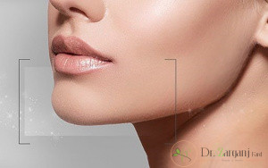 هزینه تزریق فیلر چانه