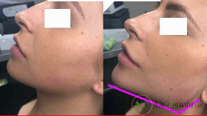 بعد از تزریق چه نکاتی را باید رعایت کرد؟