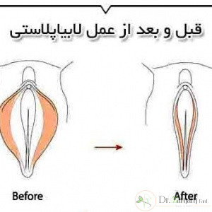 عمل لابیاپلاستی چیست؟