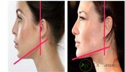 برای تزریق ژل چه نکاتی را باید در نظر داشت؟