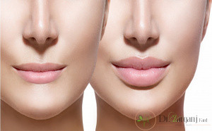طریقه تزریق ژل لب چگونه است؟