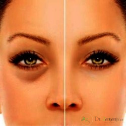 قیمت تزریق چربی برای گودی زیر چشم
