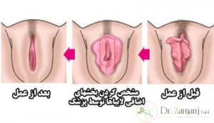 عمل لابیاپلاستی در شهرری چگونه انجام می شود؟