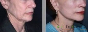 نکاتی که باید قبل و بعد از انجام تزریق بوتاکس رعایت شود؟