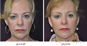 دلیل از بین رفتن تاثیرات ژل تزریقی بر روی صورت بعد از مرور زمان چیست؟