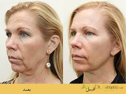 جراحی بر روی پوست و ماهیچه های ریز