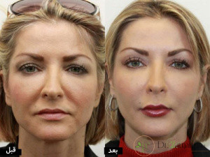 آرایش بعد از تزریق ژل