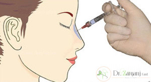 نکات مهم در تزریق ژل به بینی