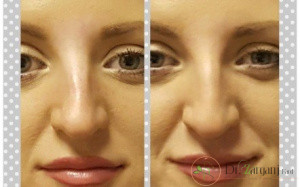 ویژگی های لیفت بینی