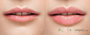 چگونگی تزریق ژل لب مدل قلبی :