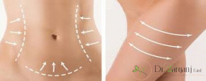 آیا بعد از انجام کویتیشن استفاده از مراقبت های خاصی پیشنهاد می شود؟