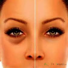 مراقبتهای بعد از تزریق ژل زیر چشم
