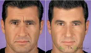 بوتاکس صورت آقایان