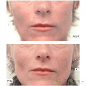 چه کسانی نباید ژل های زیبایی را تزریق کنند؟