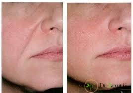 عوارض تزریق ژل خط خنده