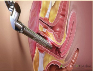 تنگ کردن واژن بدون عمل جراحی چگونه است؟