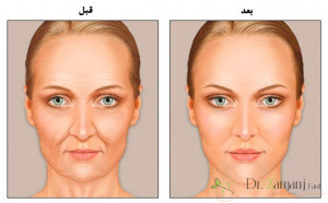 9: دلیل جابه جایی ژل صورت چیست؟