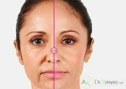 عوارض تزریق ژل زیر چشم