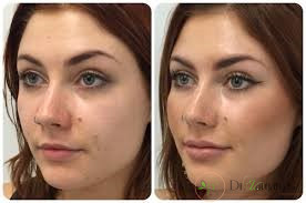 چرا ژل نورامیس اثر بخشی بالایی دارد؟
