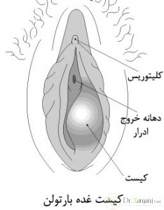علائم کیست واژن