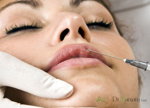 مدت زمانی که برای تاثیر ژلهای تزریقی وجود دارد چقدر است؟