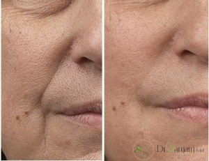مراقبتهای بعد از تزریق ژل به خط خنده