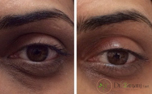 آیا گاز کربن دی اکسید تزریق شده به بدن از طریق کربوکسی تراپی دارای ضرراتی برای بیمار می باشد؟