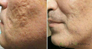 عمل کربوکسی تراپی را برای چه مواردی به کار می برند؟